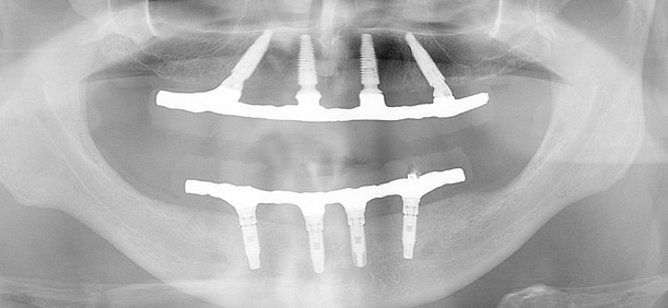 Radiografia All-on-Four Bimaxilar